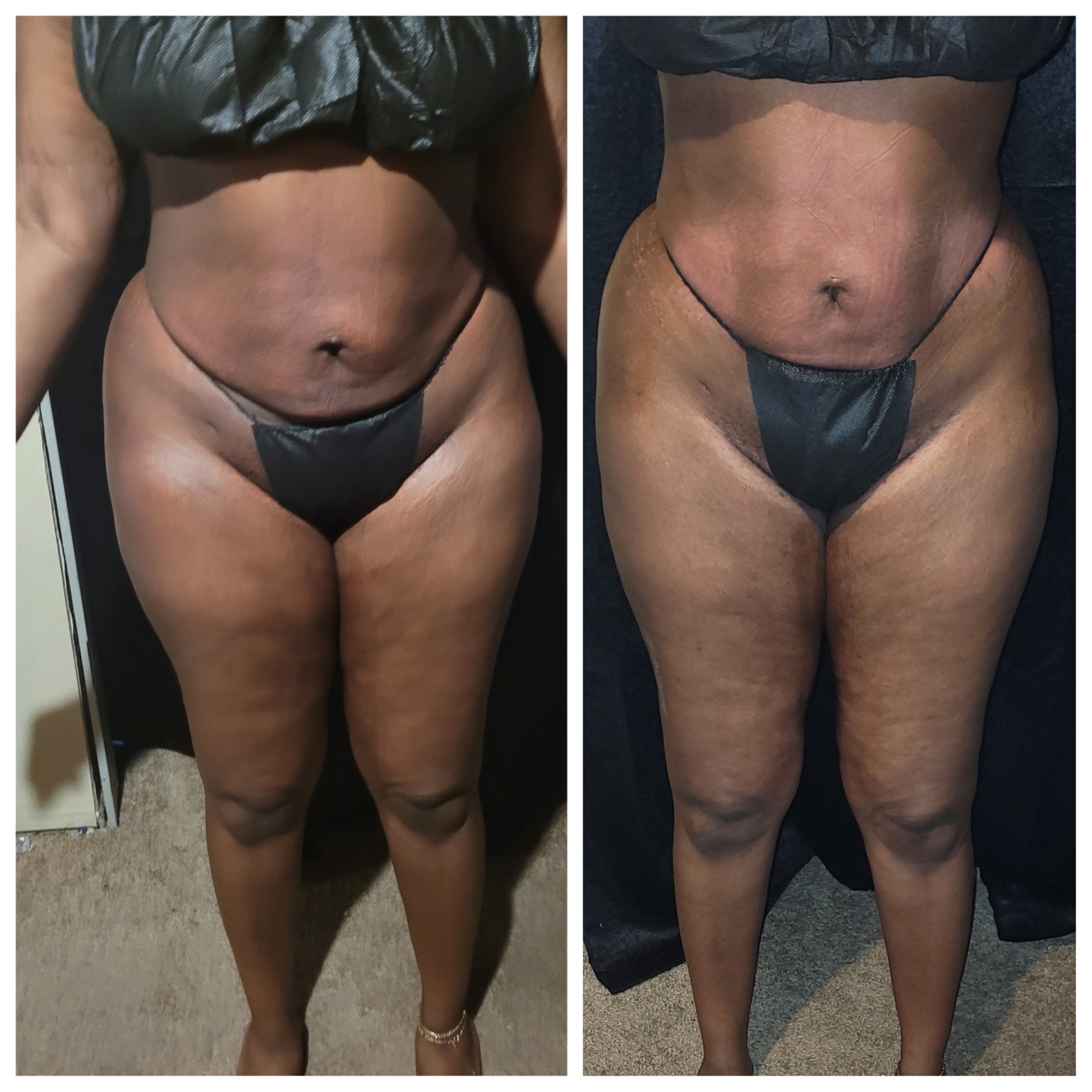 Post-surgery care before and after result